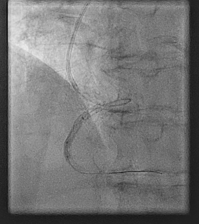The love (patient comfort, safety 🙌) and hate (horrendous support with Ca/tortuosity) relationship with Radial for complex PCI continues. It mostly starts ok, until the guide is somewhere in the mid aorta 😡 and then you wish you had gone groin. Who disagrees and why?