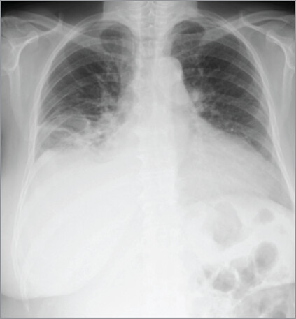 📓 New From The #THIJournal 

Endo, et al. detail endoscopic #thrombectomy to remove giant floating biventricular thrombi in a patient with restricted cardiac function. Read about their approach to this extremely rare condition:

doi.org/10.14503/THIJ-…
#thrombosis #endoscopic