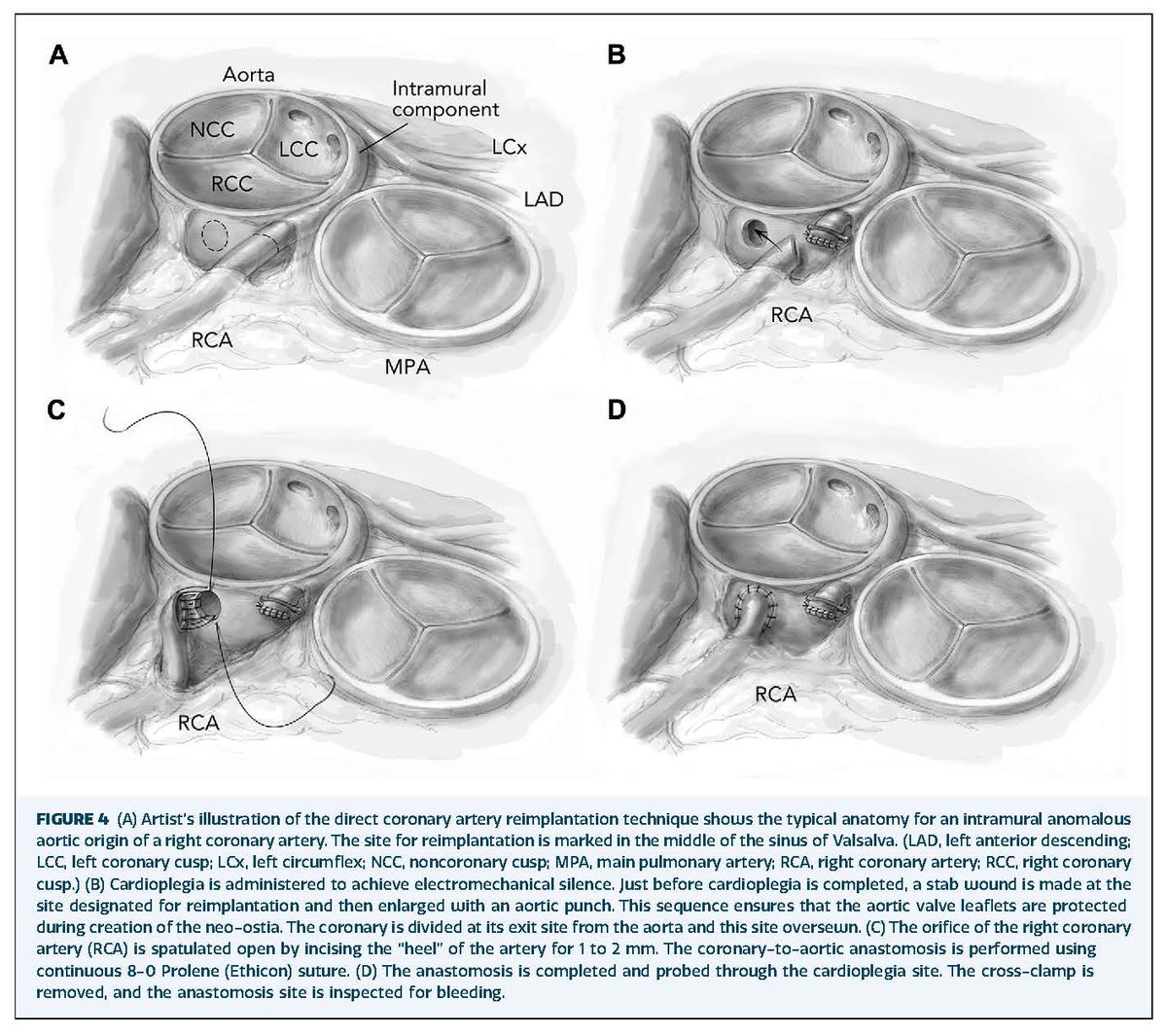 The Annals of Thoracic Surgery (@annalsthorsurg) on Twitter photo #EditorsChoice In this study, Mainwaring et al assess outcomes of patients undergoing surgery for anomalous aortic origin of a coronary artery and compare results of the unroofing and reimplantation surgical techniques. Read more👇
doi.org/10.1016/j.atho…
<a href="/shirazmaskatia/">Shiraz Maskatia</a> #EditorsChoice In this study, Mainwaring et al assess outcomes of patients undergoing surgery for anomalous aortic origin of a coronary artery and compare results of the unroofing and reimplantation surgical techniques. Read more👇
doi.org/10.1016/j.atho…
<a href="/shirazmaskatia/">Shiraz Maskatia</a>