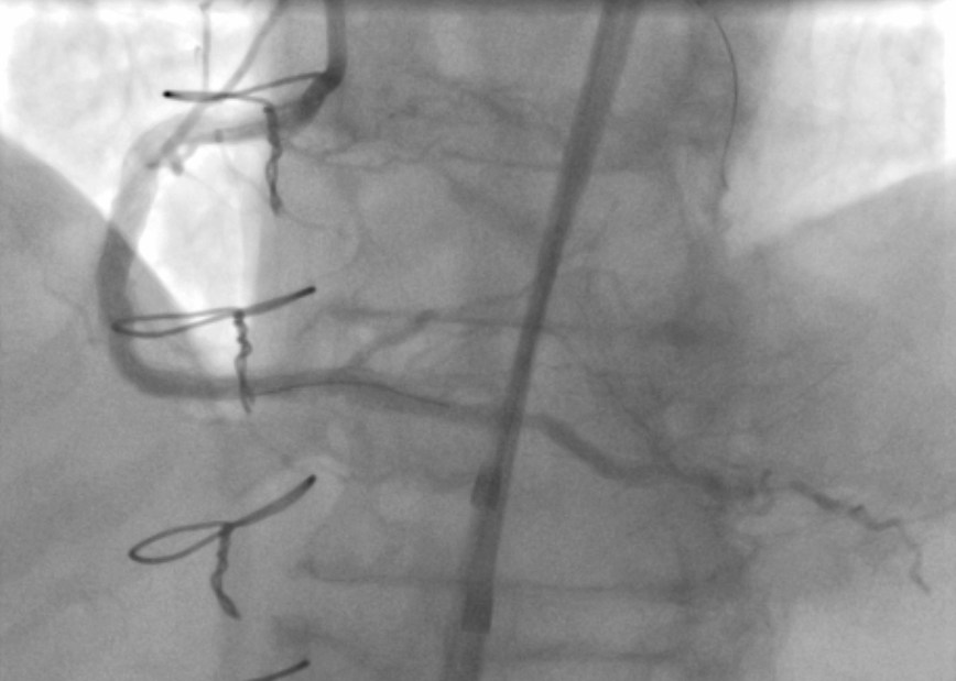 It was a great honour to participate in the international charity CTO Live Aid event with TPCH cathlab team. Post-CABG calcified RCA CTO treated with rotacut and DCB with good result for the patient.