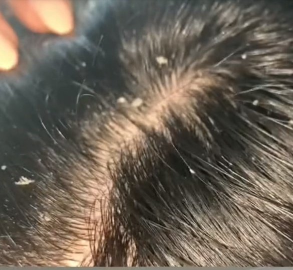 Alat ini cocok banget buat yang ngerasa kulit kepalanya kurang bersih. Khususnya buat yang ketombean, kadang ada sisik2 putih atau ketombe di kepala yang sudah buat lepas. Pake scalp scrubber ini juga bisa pijat kepala untuk relaksasi pastinya. 
s.shopee.co.id/8AK1PRVJn1