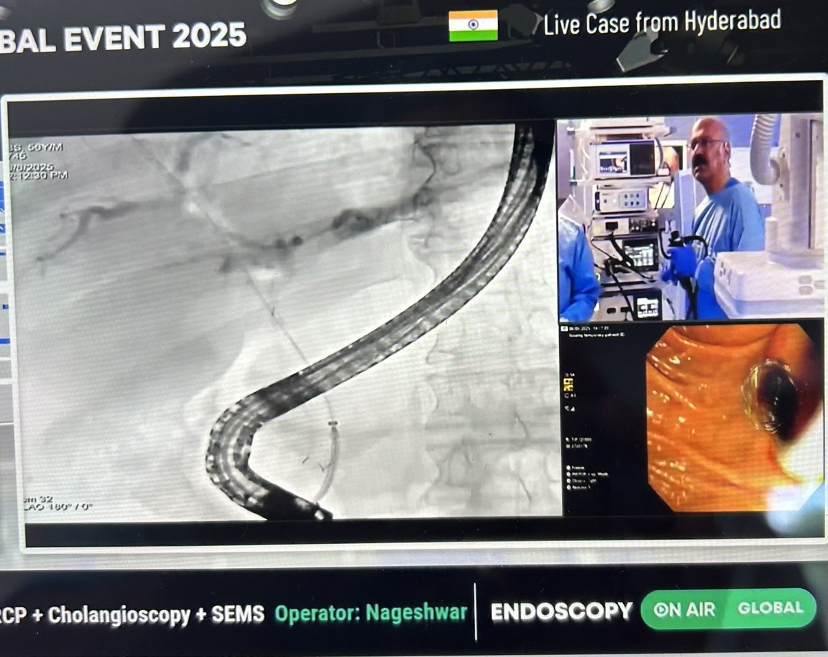 Anjan Dhar (@anjan_dhar6) on Twitter photo The Master on show live - double duct stenting after RFA for a biliary adenocarcinoma. Done in less than 15 minutes!!! And remember he is over 65ā¦.age is just a number. Assisted by the worldās best assistant Srinivas. <a href="/AIGHospitals/">AIG Hospitals</a> <a href="/alerepici/">alessandro repici</a> The Master on show live - double duct stenting after RFA for a biliary adenocarcinoma. Done in less than 15 minutes!!! And remember he is over 65ā¦.age is just a number. Assisted by the worldās best assistant Srinivas. <a href="/AIGHospitals/">AIG Hospitals</a> <a href="/alerepici/">alessandro repici</a>