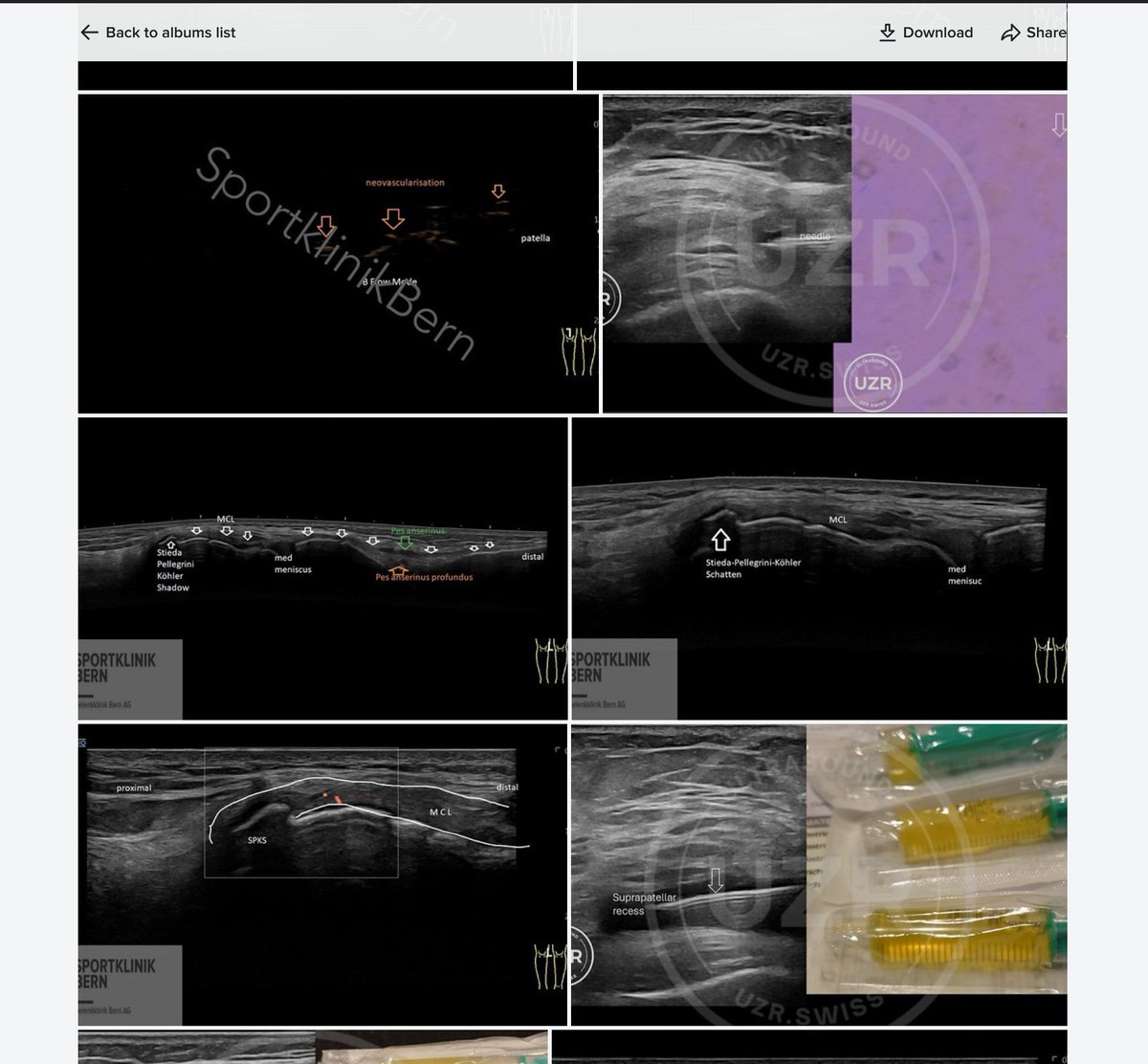 Sᴡɪss Uʟᴛʀᴀsᴏᴜɴᴅ Cᴇɴᴛᴇʀ - UZR (@rheumatology) on Twitter photo Wᴇ ᴀʀᴇ ᴘʟᴇᴀsᴇᴅ ᴛᴏ ᴘʀᴇsᴇɴᴛ ᴛʜᴇ ɴᴇᴡ 
ғʀᴇᴇ ᴜʟᴛʀᴀsᴏᴜɴᴅ ɪᴍᴀɢᴇ ᴅᴀᴛᴀʙᴀsᴇ.
Iғ ʏᴏᴜ ᴜsᴇ ɪᴍᴀɢᴇs, ᴘʟᴇᴀsᴇ ᴀʟᴡᴀʏs ɪɴᴅɪᴄᴀᴛᴇ ᴛʜᴇ ʀᴇғᴇʀᴇɴᴄᴇ.
Yᴏᴜ ᴄᴀɴ ғɪɴᴅ ɪᴍᴀɢᴇs ɪɴ ᴛʜᴇ ᴀʟʙᴜᴍs:
flickr.com/photos/1274755…
Yᴏᴜ ᴄᴀɴ ᴀʟsᴏ Wᴇ ᴀʀᴇ ᴘʟᴇᴀsᴇᴅ ᴛᴏ ᴘʀᴇsᴇɴᴛ ᴛʜᴇ ɴᴇᴡ 
ғʀᴇᴇ ᴜʟᴛʀᴀsᴏᴜɴᴅ ɪᴍᴀɢᴇ ᴅᴀᴛᴀʙᴀsᴇ.
Iғ ʏᴏᴜ ᴜsᴇ ɪᴍᴀɢᴇs, ᴘʟᴇᴀsᴇ ᴀʟᴡᴀʏs ɪɴᴅɪᴄᴀᴛᴇ ᴛʜᴇ ʀᴇғᴇʀᴇɴᴄᴇ.
Yᴏᴜ ᴄᴀɴ ғɪɴᴅ ɪᴍᴀɢᴇs ɪɴ ᴛʜᴇ ᴀʟʙᴜᴍs:
flickr.com/photos/1274755…
Yᴏᴜ ᴄᴀɴ ᴀʟsᴏ