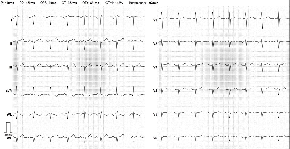 35 yo man, asymptomatic; your diagnosis?