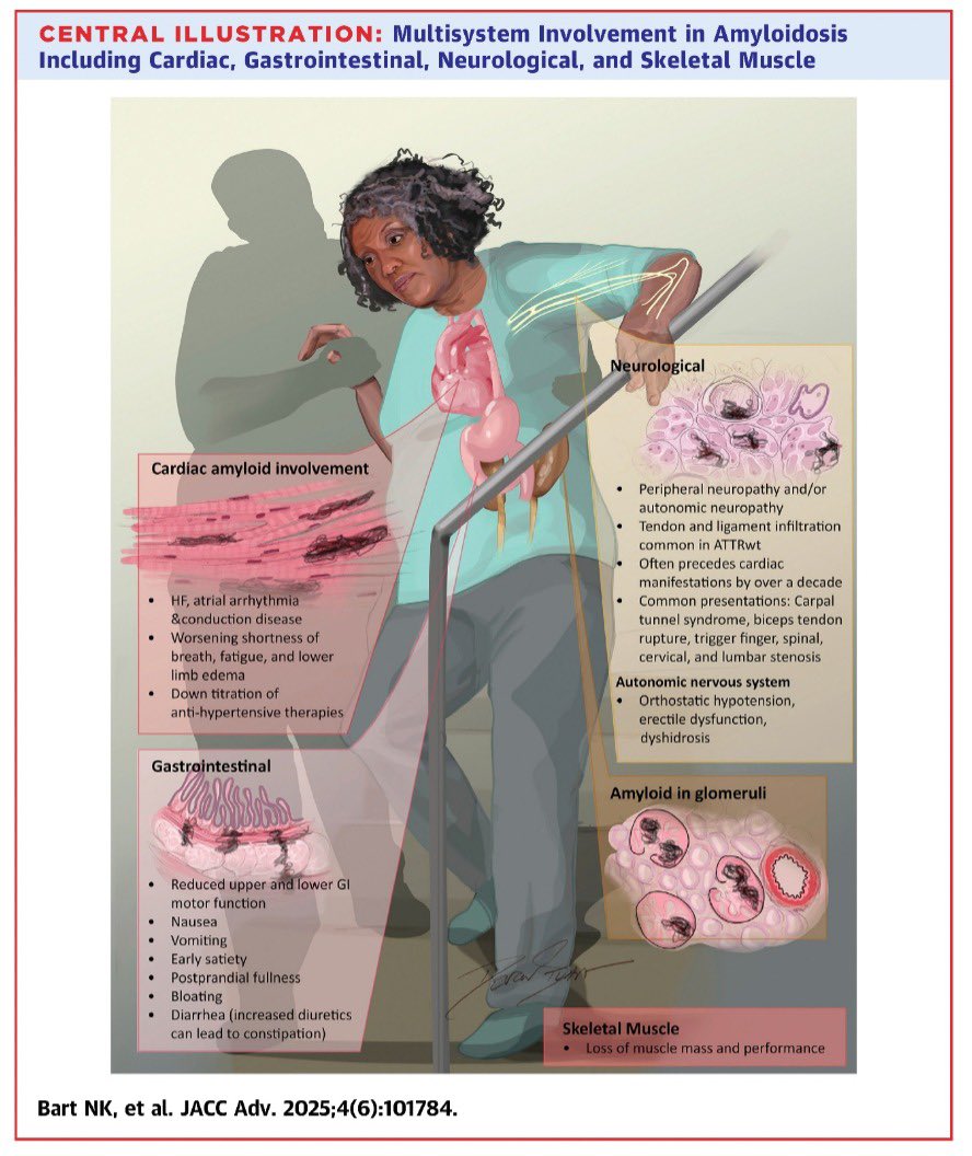 Nuevo estudio destaca el papel clave de las enfermeras en el manejo de la amiloidosis cardiaca en adultos mayores con fragilidad

👩🏽‍⚕️La amiloidosis, una enfermedad multisistémica, afecta especialmente a adultos mayores, donde la fragilidad es un factor crítico. Este artículo de