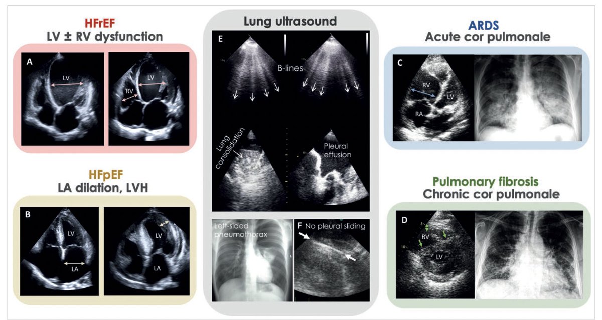 Ivan_Echocardio's tweet image. Recent advances in ultrasound examination
of the heart in the emergency cardiac care
#echofirst
DOI: 10.26430/CHUNGARICA.2025.55.2.72