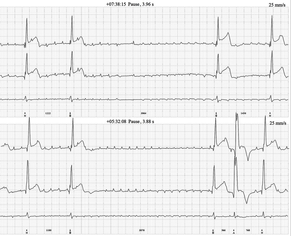 70 yo woman with palpitations; 2 Holter-strips; rhythm?