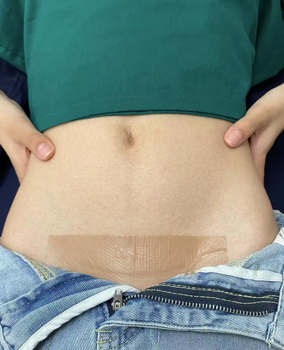 JheneShema89759's tweet image. ✨ Say goodbye to stubborn scars!
Whether it’s from a C-section, eyelid surgery, or other procedures—our Scar Care Patches are designed to fade scars, smooth skin, and support gentle healing. 
 Trusted by thousands, backed by clinical evidence.
#SiliconePatch
#WoundCare
#Scar