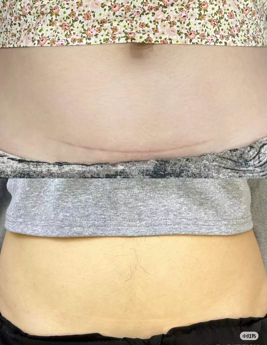 RainaZhang888's tweet image. ✨ Say goodbye to stubborn scars! Whether it’s from a C-section, eyelid surgery, or other procedures—our Scar Care Patches are designed to fade scars, smooth skin, and support gentle healing.
Trusted by thousands, backed by clinical evidence.
#SiliconePatch
#WoundCare
#Scar