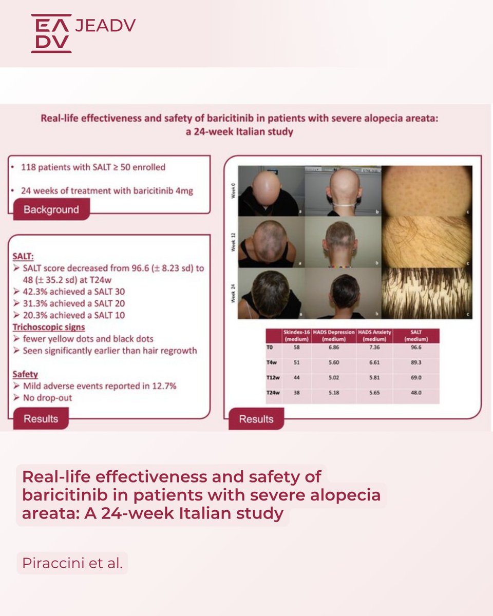 🧬 Real-world data on #Baricitinib for severe alopecia areata. This 24-week Italian multicentre study by Piraccini et al. evaluates the effectiveness and safety of baricitinib in patients with severe #AlopeciaAreata: doi.org/10.1111/jdv.20…