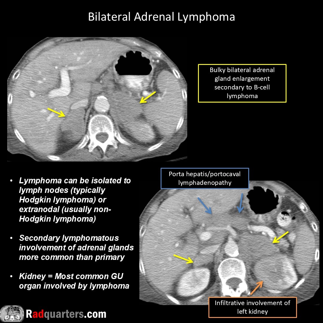 Radquarters's tweet image. #FOAMrad #FOAMed #radiology #radres #radtech #medstudent #radquarters