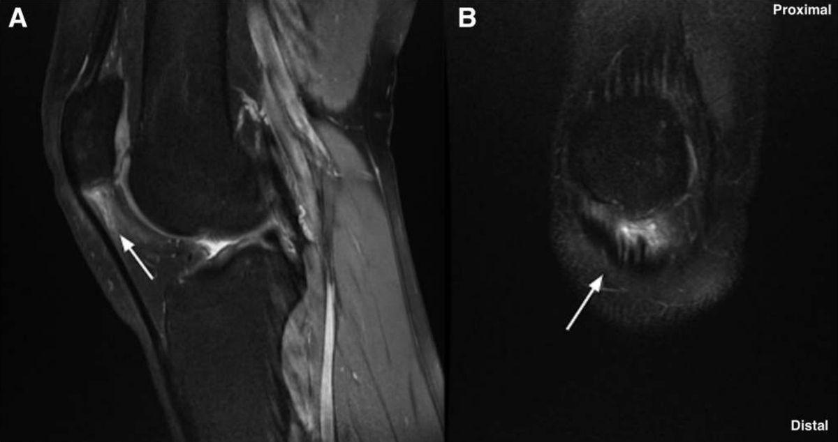 thekneedoc's tweet image. How do you treat recurrent lateral patellar instability in the presence of severe patellar tendinopathy? In this new study, Dr. LaPrade and his team present a dual-graft solution using hamstring &amp;amp; quadriceps autografts. medilink.us/b88n #medtwitter #kneeinstability