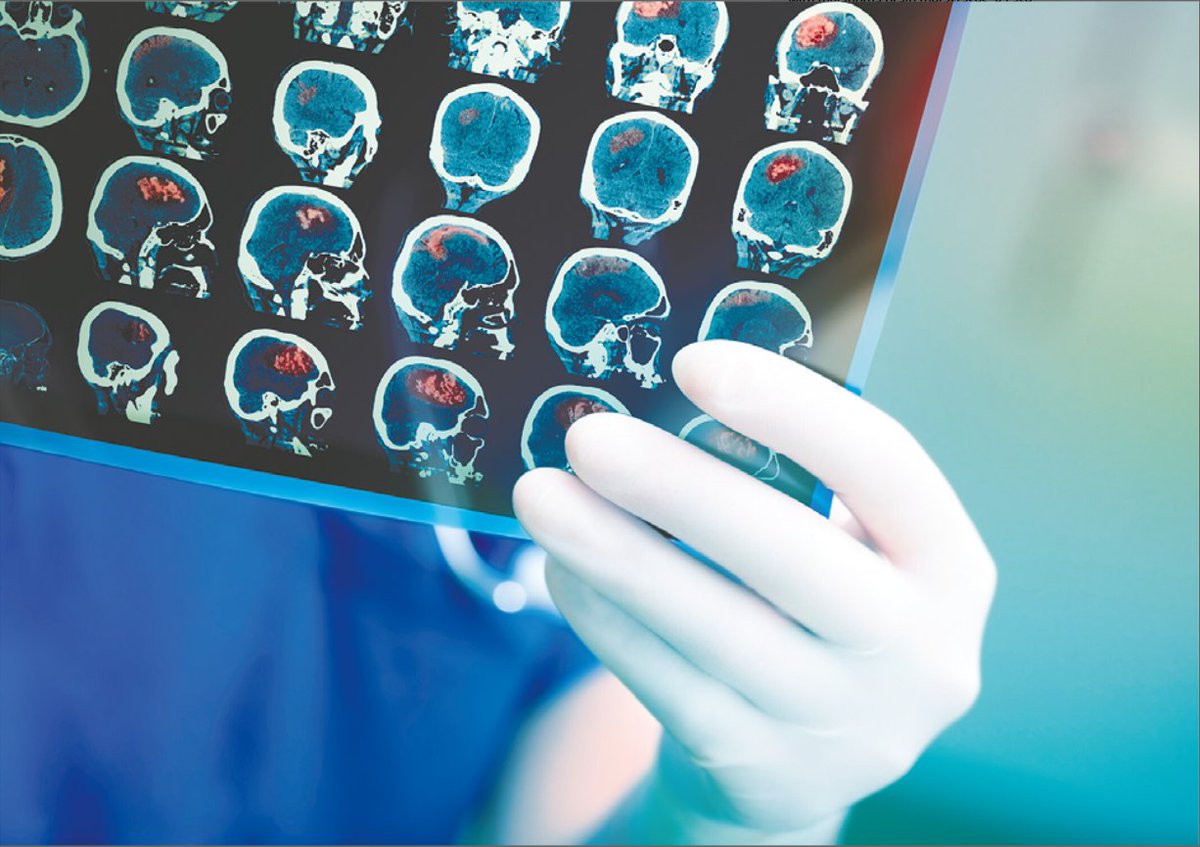 ACS Journal Cancer (@journalcancer) on Twitter photo Available in #CancerScope! A 7-year study in The Lancet Oncology shows nivolumab + ipilimumab helps people w/ melanoma brain metastases live longer 🧠
CANCER Section Editor <a href="/jasonlukemd/">Jason Luke, MD, FACP</a> explains why this combination is now the go-to treatment acsjournals.onlinelibrary.wiley.com/doi/10.1002/cn…
<a href="/OncoAlert/">OncoAlert</a> Available in #CancerScope! A 7-year study in The Lancet Oncology shows nivolumab + ipilimumab helps people w/ melanoma brain metastases live longer 🧠
CANCER Section Editor <a href="/jasonlukemd/">Jason Luke, MD, FACP</a> explains why this combination is now the go-to treatment acsjournals.onlinelibrary.wiley.com/doi/10.1002/cn…
<a href="/OncoAlert/">OncoAlert</a>
