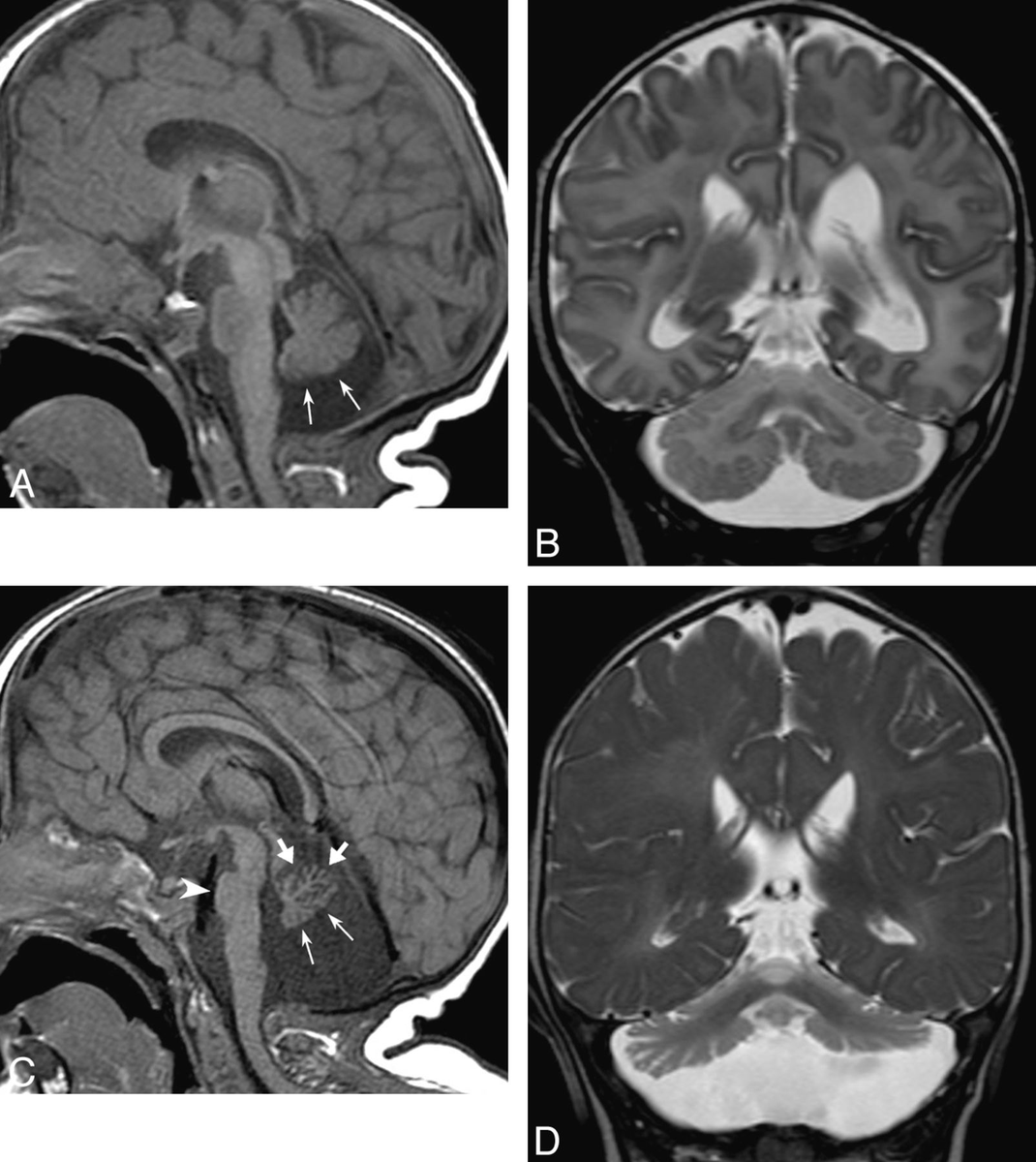 NeuroimagingDB's tweet photo. Congenital disorders of glycosylation (CDG)
✅蛋白や脂質のグリコシル化異常に伴うPurkinje細胞の障害
✅小脳（特に虫部）の高度萎縮とT2延長、橋の萎縮をきたす
✅発達遅滞、小脳症状、末梢神経症状、特徴的な顔貌を呈する
PMID: 22723063 https://t.co/myN9s3y7Am