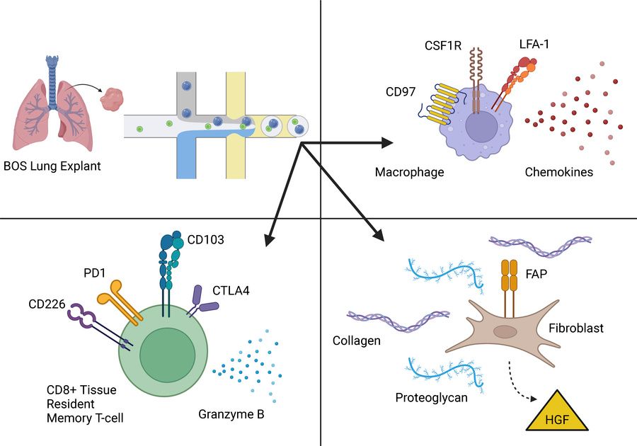 ASCI member <a href="/GillSaar/">Saar Gill</a> et al. <a href="/PennMedicine/">Penn Medicine</a> show that obliterative bronchiolitis after lung or hematopoietic stem cell transplantation is characterized by an expansion of activated tissue resident memory T cells, macrophage chemotaxis and proliferation, and dysfunctional stromal