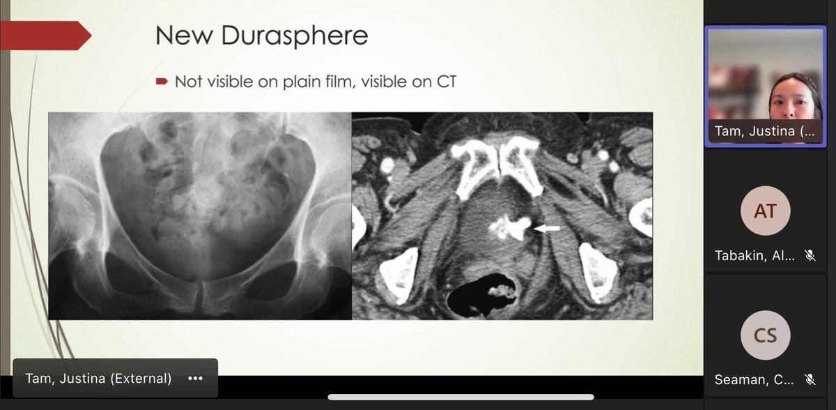 Allie Tabakin, MD (@allie_tabakin) on Twitter photo What is that lady lump? 🤔
✏️An awesome and informative grand rounds by <a href="/jtinatam/">Justina Tam</a> of <a href="/SBUrology/">Stony Brook Urology</a> reminding us that not all vaginal masses are prolapse!
🩻 History taking is key because even imaging may be misleading
#URPS #UroSoMe <a href="/sufuorg/">SUFU</a> <a href="/urogynsociety/">AUGS</a> What is that lady lump? 🤔
✏️An awesome and informative grand rounds by <a href="/jtinatam/">Justina Tam</a> of <a href="/SBUrology/">Stony Brook Urology</a> reminding us that not all vaginal masses are prolapse!
🩻 History taking is key because even imaging may be misleading
#URPS #UroSoMe <a href="/sufuorg/">SUFU</a> <a href="/urogynsociety/">AUGS</a>