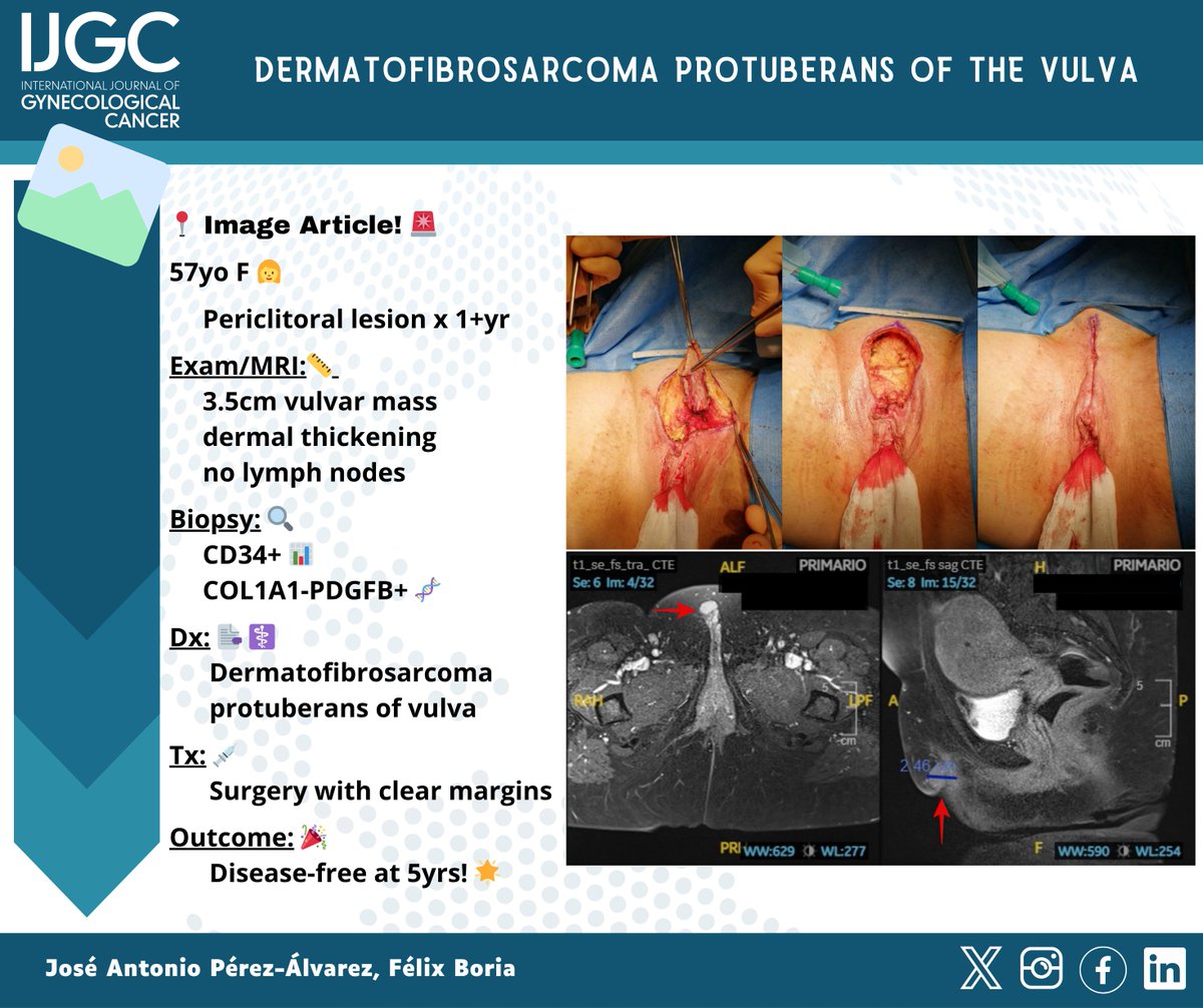 IJGC (@ijgconline) on Twitter photo From mystery nodule to rare diagnosis: vulvar DFSP conquered with surgery— disease free 5 years later! 🌟💪✨ by <a href="/BoriaFelix/">Felix Boria</a>
Read more @ bit.ly/4jt8E5J
<a href="/pedroramirezMD/">Pedro T Ramirez</a> <a href="/HsuMd/">Arthur_HC_Hsu</a> <a href="/JayrajAarthi/">Aarthi S Jayraj</a> <a href="/AndreFernandes2/">Andreina Fernandes</a> <a href="/IGCSociety/">IGCS</a> <a href="/ESGO_society/">ESGO</a> <a href="/ENYGO_official/">European Network of Young Gynae Oncologists</a> <a href="/OncoAlert/">OncoAlert</a> From mystery nodule to rare diagnosis: vulvar DFSP conquered with surgery— disease free 5 years later! 🌟💪✨ by <a href="/BoriaFelix/">Felix Boria</a>
Read more @ bit.ly/4jt8E5J
<a href="/pedroramirezMD/">Pedro T Ramirez</a> <a href="/HsuMd/">Arthur_HC_Hsu</a> <a href="/JayrajAarthi/">Aarthi S Jayraj</a> <a href="/AndreFernandes2/">Andreina Fernandes</a> <a href="/IGCSociety/">IGCS</a> <a href="/ESGO_society/">ESGO</a> <a href="/ENYGO_official/">European Network of Young Gynae Oncologists</a> <a href="/OncoAlert/">OncoAlert</a>