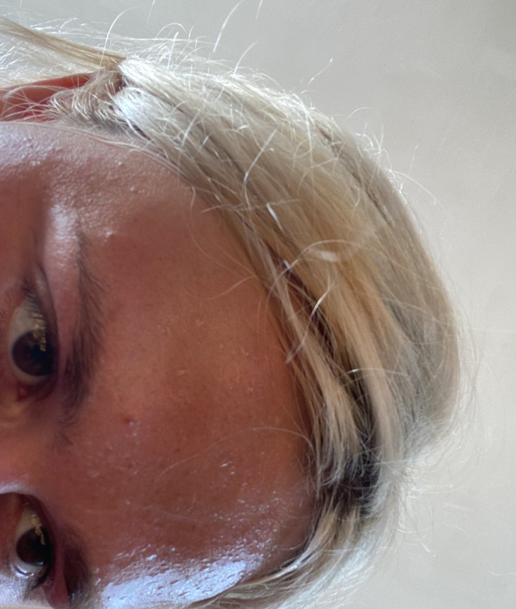 Ммм це я в 25 років з тиском 190 прошу вас задонатить трошки грошів. Скільки крапель на чолі нарахували стільки і киньте або хочаб 10 гривнів бумласка😢 send.monobank.ua/jar/83vh8ue79T