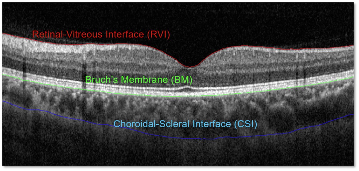 AAOjournal's tweet image. The Non-invasive Measurement of Ocular Rigidity and the Pulsatile Choroidal Volume Change in Children and Young Adults
ow.ly/UovS50VLizg
#ophthalmology