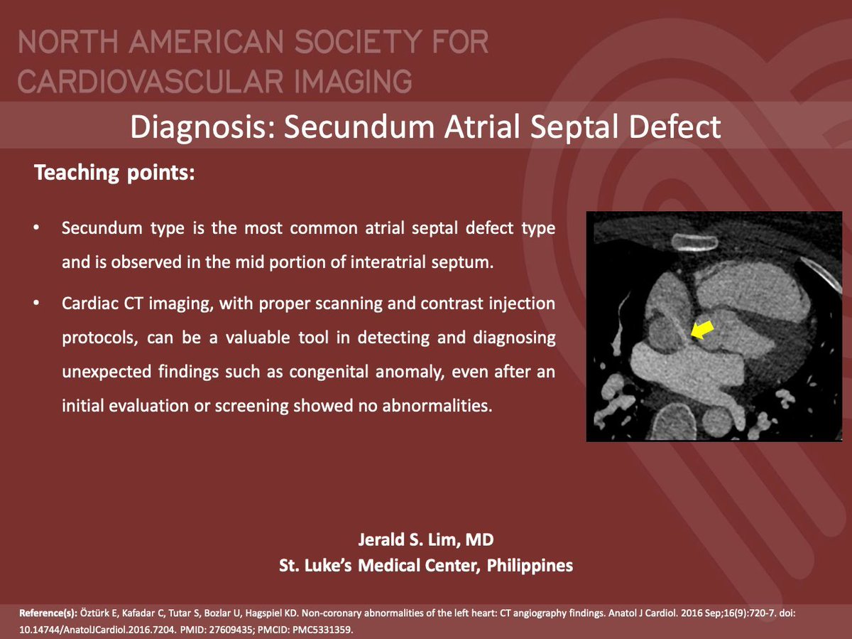 NASCISociety's tweet image. #NASCI Case Series
Case 80 Diagnosis
Courtesy of Jerald S. Lim @jgl_md from St. Luke’s Medical Center, Philippines
#whyCMR #YesCCT
@GregKicska @JRevRad1 @dianalitmano @DanielVargasMD @kirschj @prachipagarwal @AwsHamid5 @EscrOffice @CarlottaOnnis @DeCeccoCN