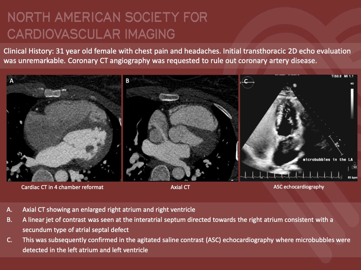 NASCISociety's tweet image. #NASCI Case Series
Case 80 Diagnosis
Courtesy of Jerald S. Lim @jgl_md from St. Luke’s Medical Center, Philippines
#whyCMR #YesCCT
@GregKicska @JRevRad1 @dianalitmano @DanielVargasMD @kirschj @prachipagarwal @AwsHamid5 @EscrOffice @CarlottaOnnis @DeCeccoCN