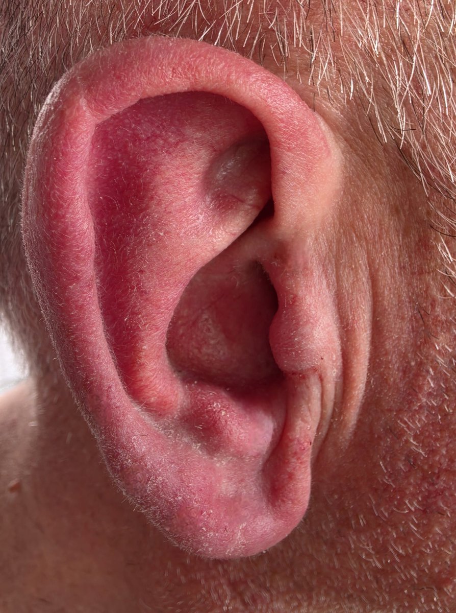 I don't show this very often but this is a before and after what it looks like when some guys have pretty hairy ears this waxing  last about 3 to 4 weeks
