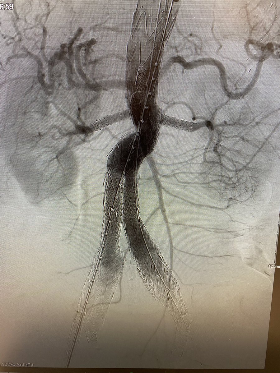 BillBeckerman's tweet image. Our PGY4 @RWJMS resident @Chamiltonians presents our workflow for in-situ laser fenestration in complex aortic disease at #VAM2025.
Great discussion about how and when to use this technique vs PMEG or TAMBE.
(W/ many thanks to all who helped us refine our technique over the yrs)