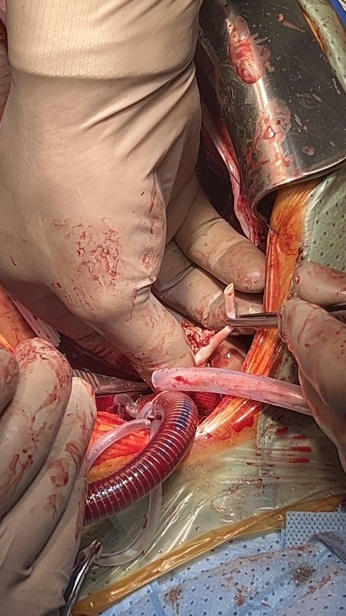 это мы катетер диализный доставали из верхней полой вены, который там стоял тучу лет, закальцинировался и доставлял кучу хлопот.