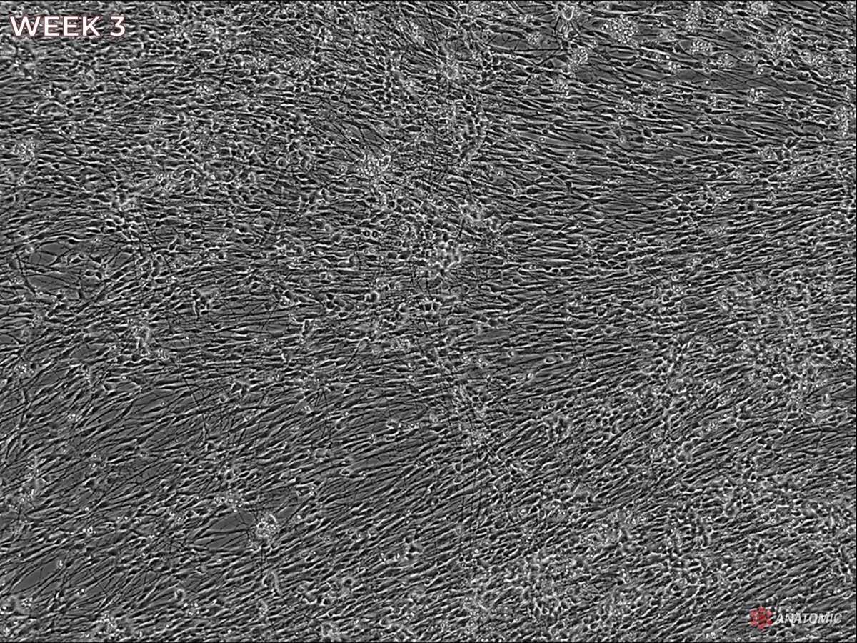 AnatomicTech's tweet image. Motor neurons alone can&apos;t explain ALS or CMT. Schwann Cell Precursors reveal how disrupted glial-neuronal crosstalk drives disease. Co-cultures model early pathogenesis, glial dysfunction, and myelination defects more accurately

#CompleteTheCircuit #NotYourAverageNeuron