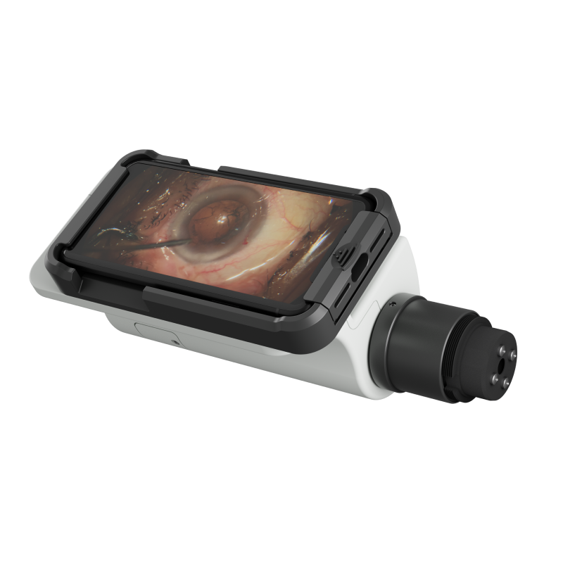 bsmedicom's tweet image. Now livestream or record HD surgery videos from microscope with iPhone. Wireless sharing &amp;amp; integration with EMR. For details visit bsmedicom.com/for-eyes/recor…
#remidio #microscoperecording #bsmedicom #mrd #recordingdevice #surgeryrecordingdevice
