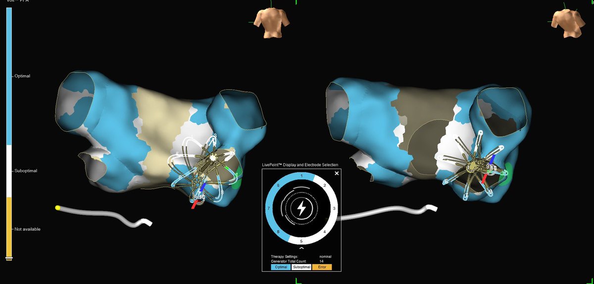 GustavoRRodrigues (@life_activist_) on Twitter photo 2 different approaches in 2 different patients. Which one will be the future? AF + typical flutter ablation in the same procedure - one with VOL PFA and other with RF. @PatriciaMatias @Padragao <a href="/guilhermeflor/">Guilherme Flor</a> <a href="/LiaMarquesEP/">Lia Marques</a> <a href="/MV_MartaValente/">Marta Félix Valente</a> <a href="/JoanaPinho92/">Joana Pinho</a>
#epeeps 2 different approaches in 2 different patients. Which one will be the future? AF + typical flutter ablation in the same procedure - one with VOL PFA and other with RF. @PatriciaMatias @Padragao <a href="/guilhermeflor/">Guilherme Flor</a> <a href="/LiaMarquesEP/">Lia Marques</a> <a href="/MV_MartaValente/">Marta Félix Valente</a> <a href="/JoanaPinho92/">Joana Pinho</a>
#epeeps