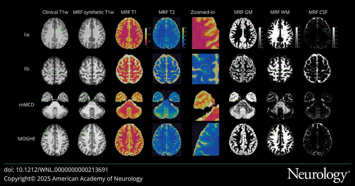 Neurology Journal (@greenjournal) on Twitter photo This study developed a magnetic resonance fingerprinting-based deep-learning framework for whole-brain focal cortical dysplasia detection. Read more:
hubs.la/Q03q-ckB0
#NeuroX This study developed a magnetic resonance fingerprinting-based deep-learning framework for whole-brain focal cortical dysplasia detection. Read more:
hubs.la/Q03q-ckB0
#NeuroX