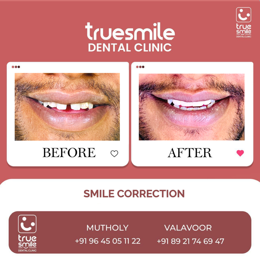 True Smile Dental Clinic (@clinictrue) on Twitter photo โจ ๐๐ซ๐๐ง๐ฌ๐๐จ๐ซ๐ฆ ๐๐จ๐ฎ๐ซ ๐๐ฆ๐ข๐ฅ๐ ๐ฐ๐ข๐ญ๐ก ๐๐จ๐ง๐๐ข๐๐๐ง๐๐! โจ
At ๐๐ซ๐ฎ๐ ๐๐ฆ๐ข๐ฅ๐ ๐๐๐ง๐ญ๐๐ฅ ๐๐ฅ๐ข๐ง๐ข๐, we believe that every smile has the power to light up a room and weโre here to help you smile with pride! ๐๐ซ โจ ๐๐ซ๐๐ง๐ฌ๐๐จ๐ซ๐ฆ ๐๐จ๐ฎ๐ซ ๐๐ฆ๐ข๐ฅ๐ ๐ฐ๐ข๐ญ๐ก ๐๐จ๐ง๐๐ข๐๐๐ง๐๐! โจ
At ๐๐ซ๐ฎ๐ ๐๐ฆ๐ข๐ฅ๐ ๐๐๐ง๐ญ๐๐ฅ ๐๐ฅ๐ข๐ง๐ข๐, we believe that every smile has the power to light up a room and weโre here to help you smile with pride! ๐๐ซ