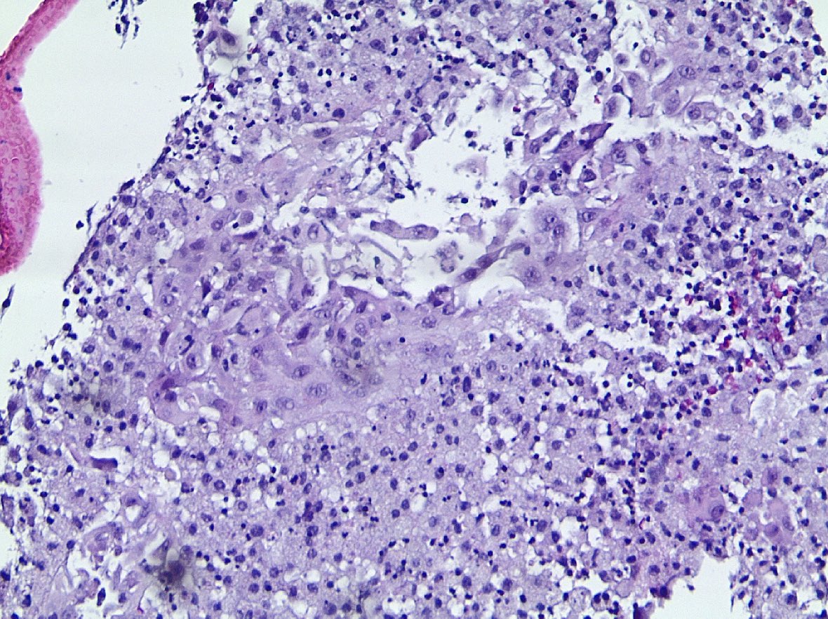 mhassanaimc's tweet image. 50/F with palpable breast mass with p63 loss (no brown stain) and Keratin (red) is shown. You call cancer: Patient gets mastectomy. You call benign nothing happens. What would you call? #breastpath