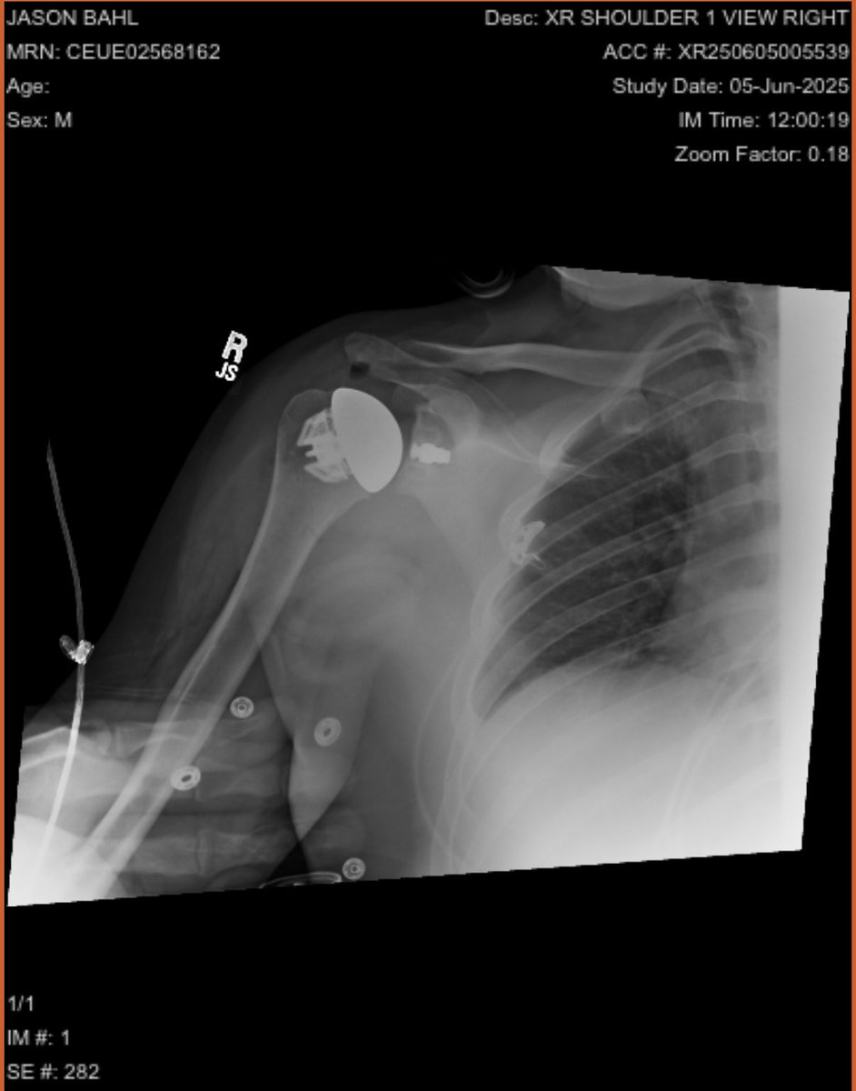 New Shoulder ✅ 

Next stop, Air-fried pizza 🍕 😆