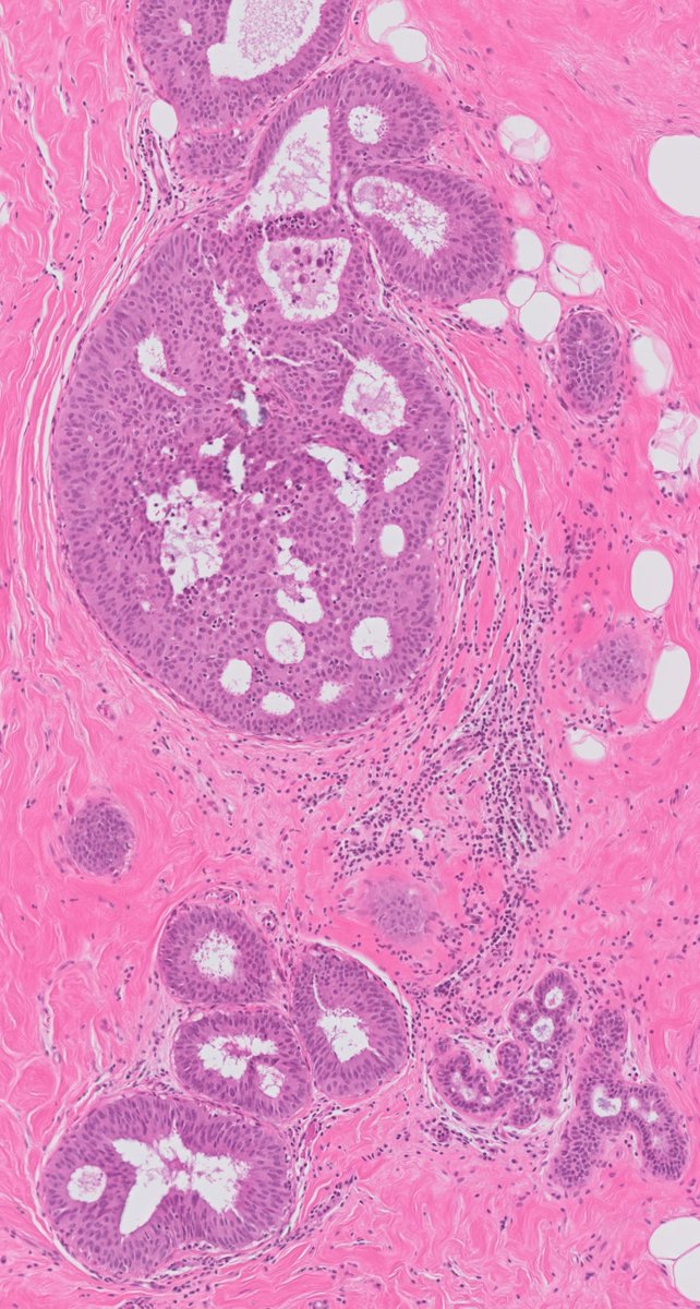 Charles Herndon (@drcyclopath) on Twitter photo Breast biopsy.
What is the most appropriate diagnosis?
A) Atypical Ductal Hyperplasia (ADH)
B) Ductal Carcinoma In Situ (DCIS), Low Grade
C) Usual Ductal Hyperplasia (UDH)
D) Flat Epithelial Atypia (FEA)
WSI: learn.mghpathology.org/index.php/DZI1β¦
#PathTwitter #Pathology #BreastPath Breast biopsy.
What is the most appropriate diagnosis?
A) Atypical Ductal Hyperplasia (ADH)
B) Ductal Carcinoma In Situ (DCIS), Low Grade
C) Usual Ductal Hyperplasia (UDH)
D) Flat Epithelial Atypia (FEA)
WSI: learn.mghpathology.org/index.php/DZI1β¦
#PathTwitter #Pathology #BreastPath