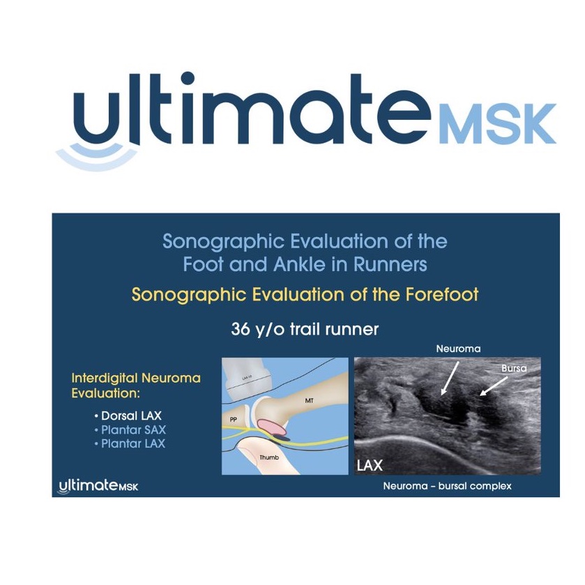 New Free Video!
The Sonographic Evaluation of Foot &amp; Ankle Injuries in Runners is now live on UltimateMSK.com!
Watch it free via the Homepage or Community Hub.
#MSKUS #SportsMedicine #RunningInjuries #FootAndAnkle #Ultrasound #MedEd #UltimateMSK