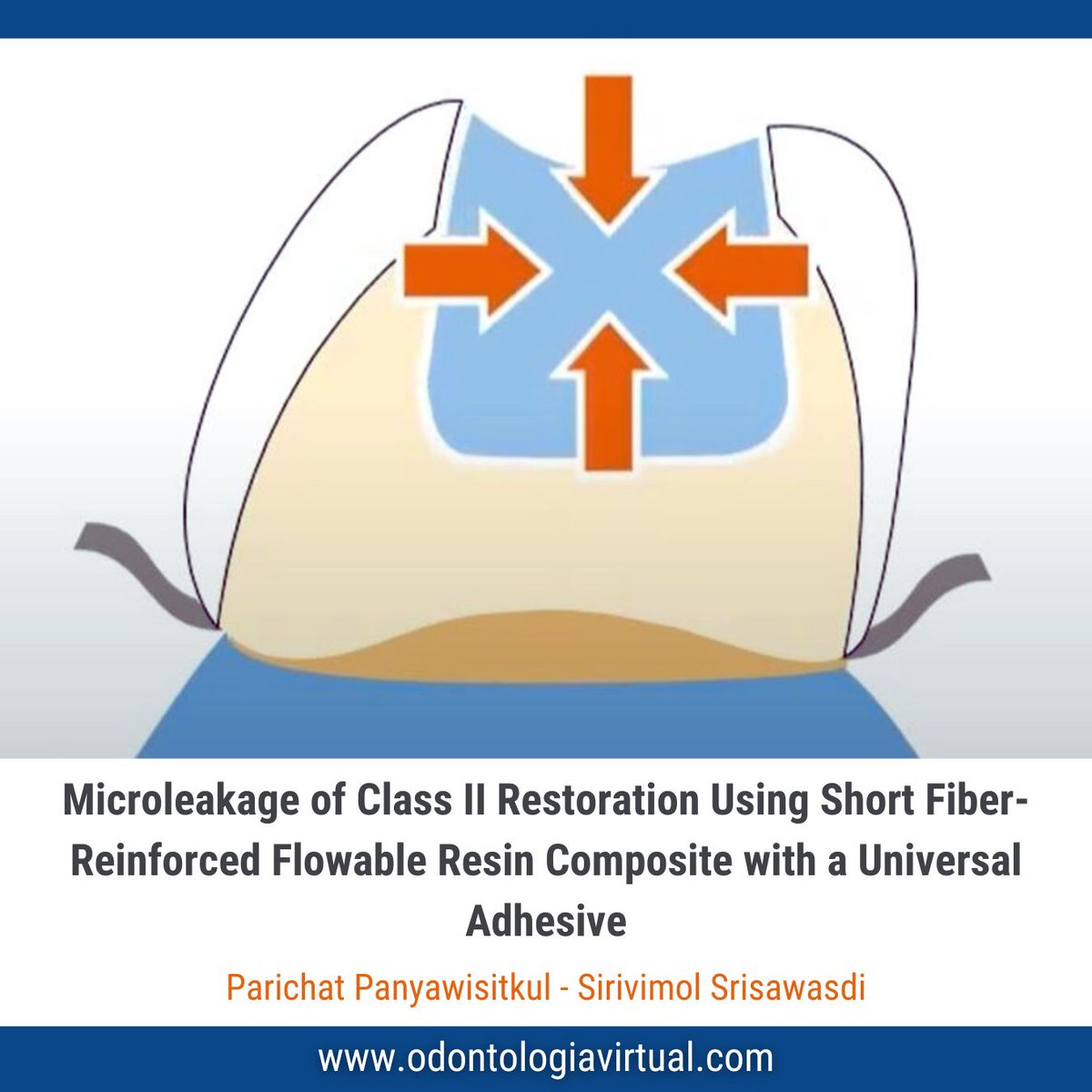 LINK odontologiavirtual.com/2024/09/compos…

The incorporation of fiber into resin composite material stems from industrial demands for high-strength material that could withstand stress in load-bearing areas. 

Consequently, short fiber-reinforced resin composite (SFRC) was introduced in 2013