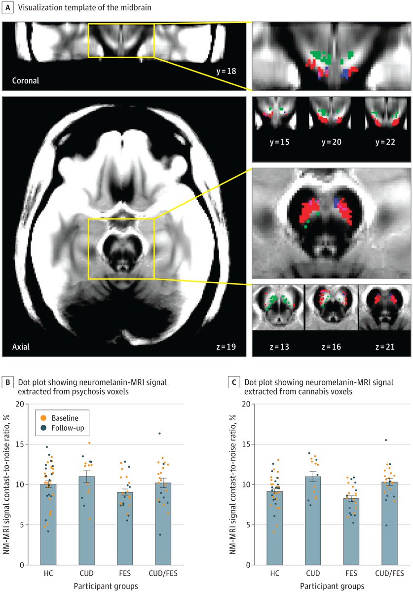 Individuals with cannabis use disorder showed elevated midbrain dopamine function, potentially linking cannabis use to an increased risk of psychosis. ja.ma/44pyTpr