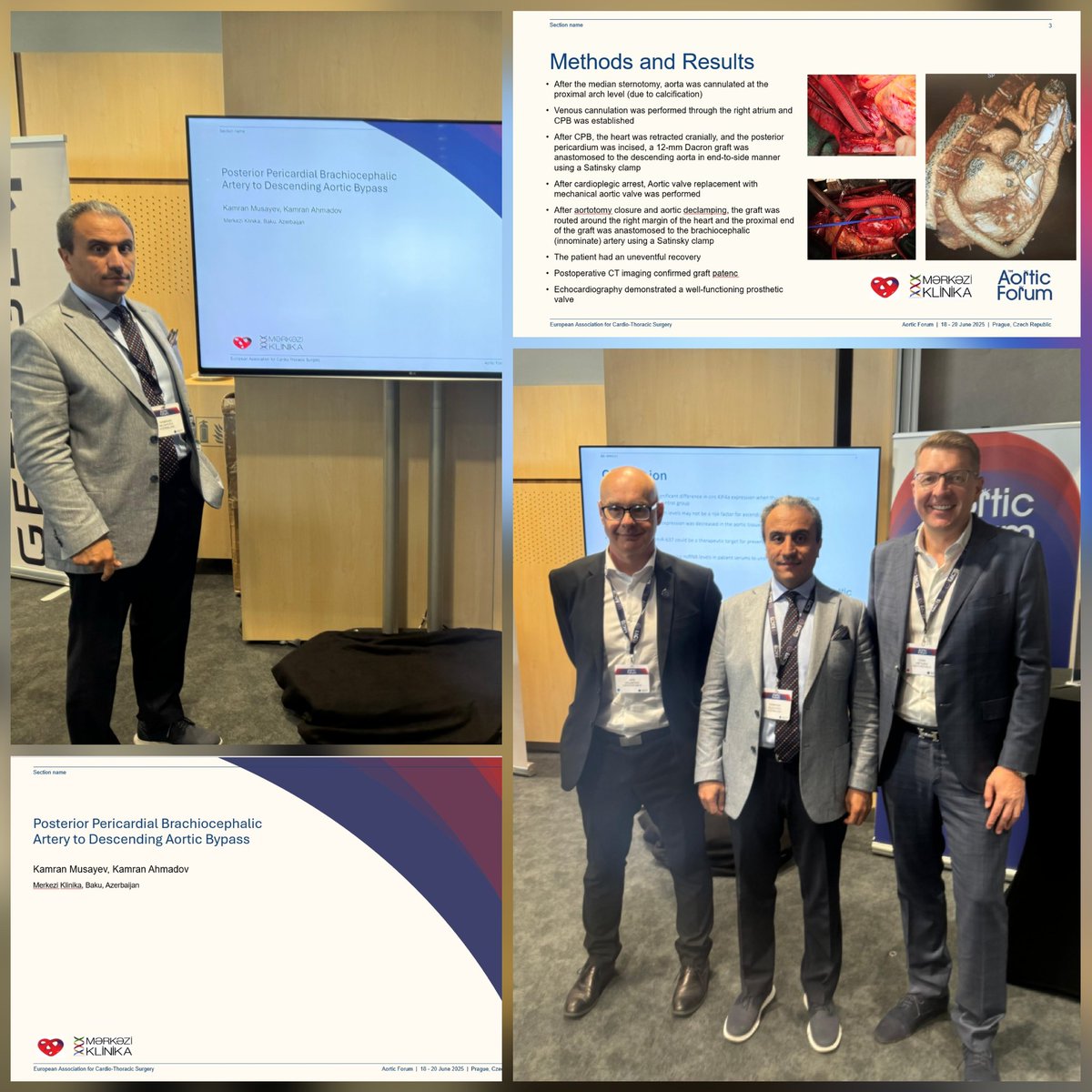 We also shared our experience with our colleagues at the Aortic Forum organized by the <a href="/EACTS/">EACTS</a> 
The special attention and care shown to us by the co-chairs of the Forum - Prof.Dr. Jan Vojacek and Prof.Dr. Ivan Netuka was very honorable. 
#EACTS #aorticforum #aorticsurgery