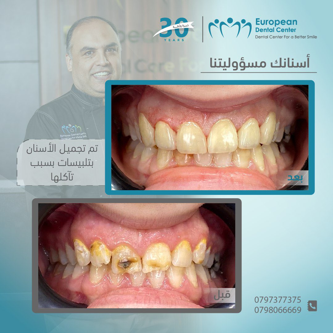 تآكل الأسنان من المشكلة الشائعة التي يمكن أن تؤدي إلى حساسية، وتغير في شكل السن، وحتى مشاكل في المضغ.
وتعتبر تلبيسات الأسنان الحل الأكثر شمولية وتغطية، وتُستخدم عندما يكون التآكل كبيرًا جدًا، أو عندما يكون السن ضعيفًا ومعرضًا للكسر، أو حتى بعد علاج العصب.
 التاج يغطي السن بالكامل