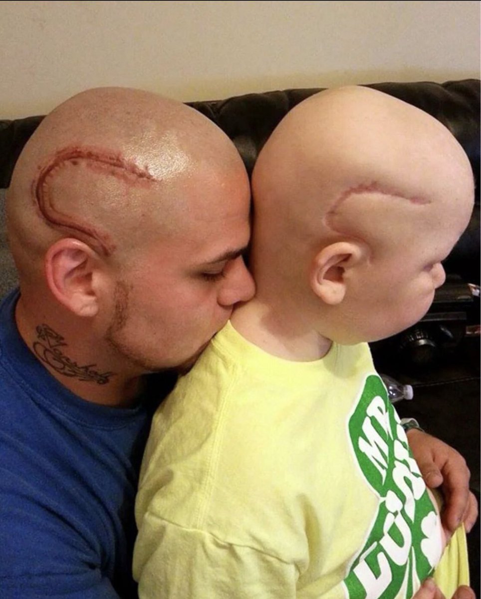 Dad got a tattoo to match his sons brain cancer surgery scar