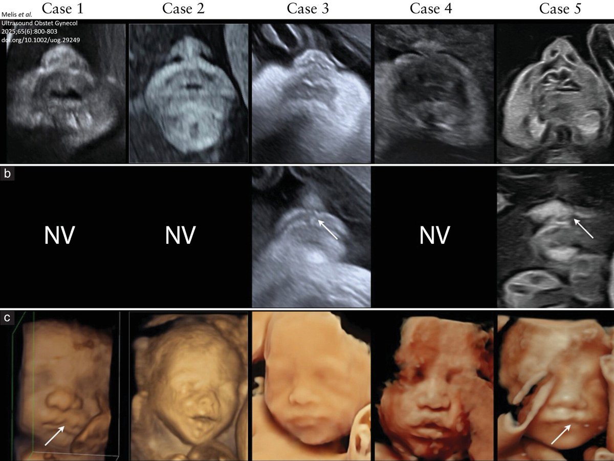 Letter to the Editor by Melis et al. in June #UOGJournal presents ultrasonographic features associated with five cases of isolated cleft lip on 2D and 3D prenatal ultrasound imaging, showing asymmetric appearance of the nostrils. bit.ly/4nazy5G