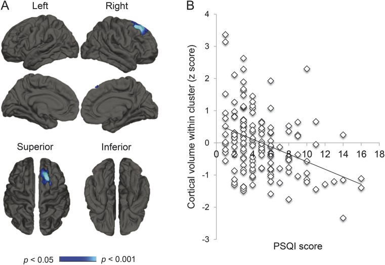 NTFabiano's tweet image. Poor sleep is associated with brain shrinkage