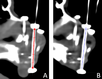 There's no high-quality #brachytherapy service without #quality #control #QC and #assurance #QA, not only for #headandneck applications:
termedia.pl/Quality-contro…
#gravity #matters
#ThisIsBrachytherapy #Interventional #radiotherapy #IRT #BT #jocb