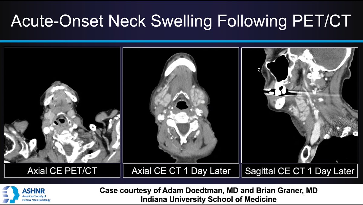 ASHNRSociety's tweet image. #ASHNRCOTW #302: Swelling. Drs. Doedtman + Graner 4 case! #ASHNR25
Answer w/ appropriate GIF only -- stay professional & don't spoil it!
@callyrobs @DShatzkes @CDP_Rad @rhwiggins @nakoontz @KRileyMD @CMGlastonbury @tabby_kennedy @PhilipRChapman1 @cmtomblinson @amyfjuliano…