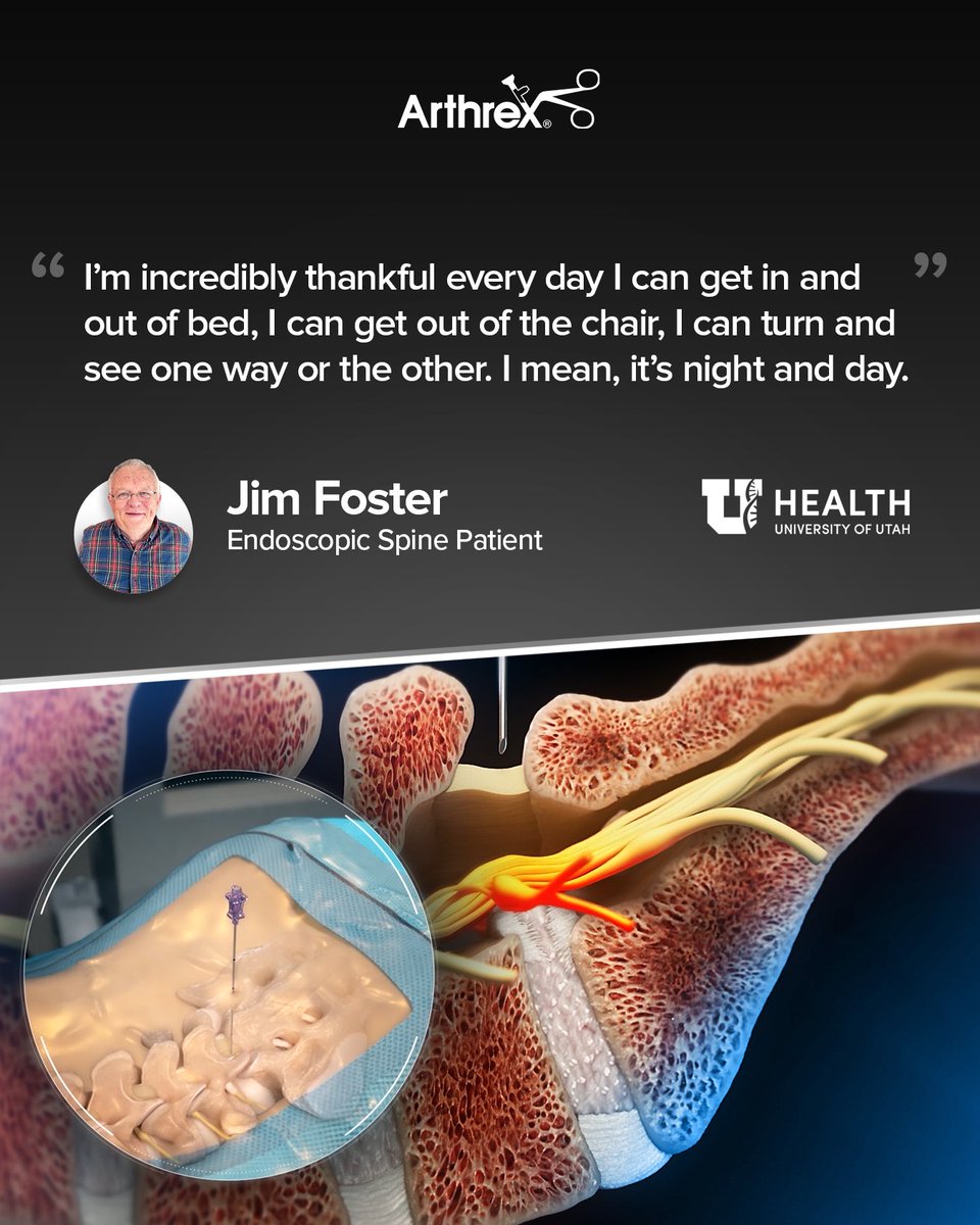 ArthrexSpine's tweet image. Despite a series of setbacks, retired basketball coach Jim Foster didn’t let back pain win. 💪
He turned to #Arthrex faculty surgeon Mark Mahan, MD, who took an ultra-minimally invasive endoscopic approach to treat multiple spine injuries Jim accumulated over several years.…