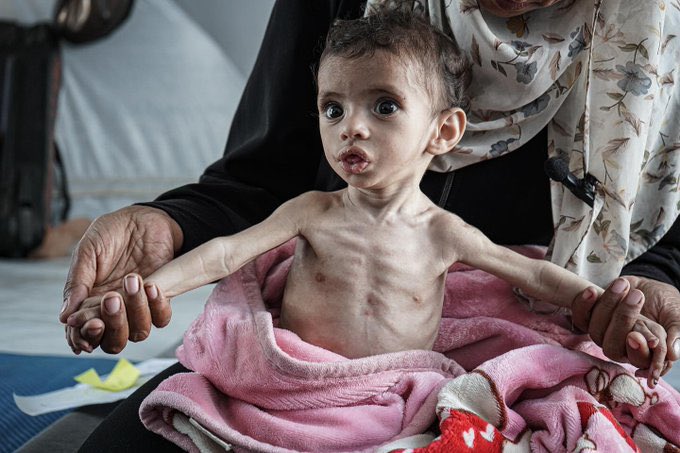 Zakaria al Mabhoh, 11 months, is suffering from severe malnutrition due to Israeli enforced starvation in Gaza