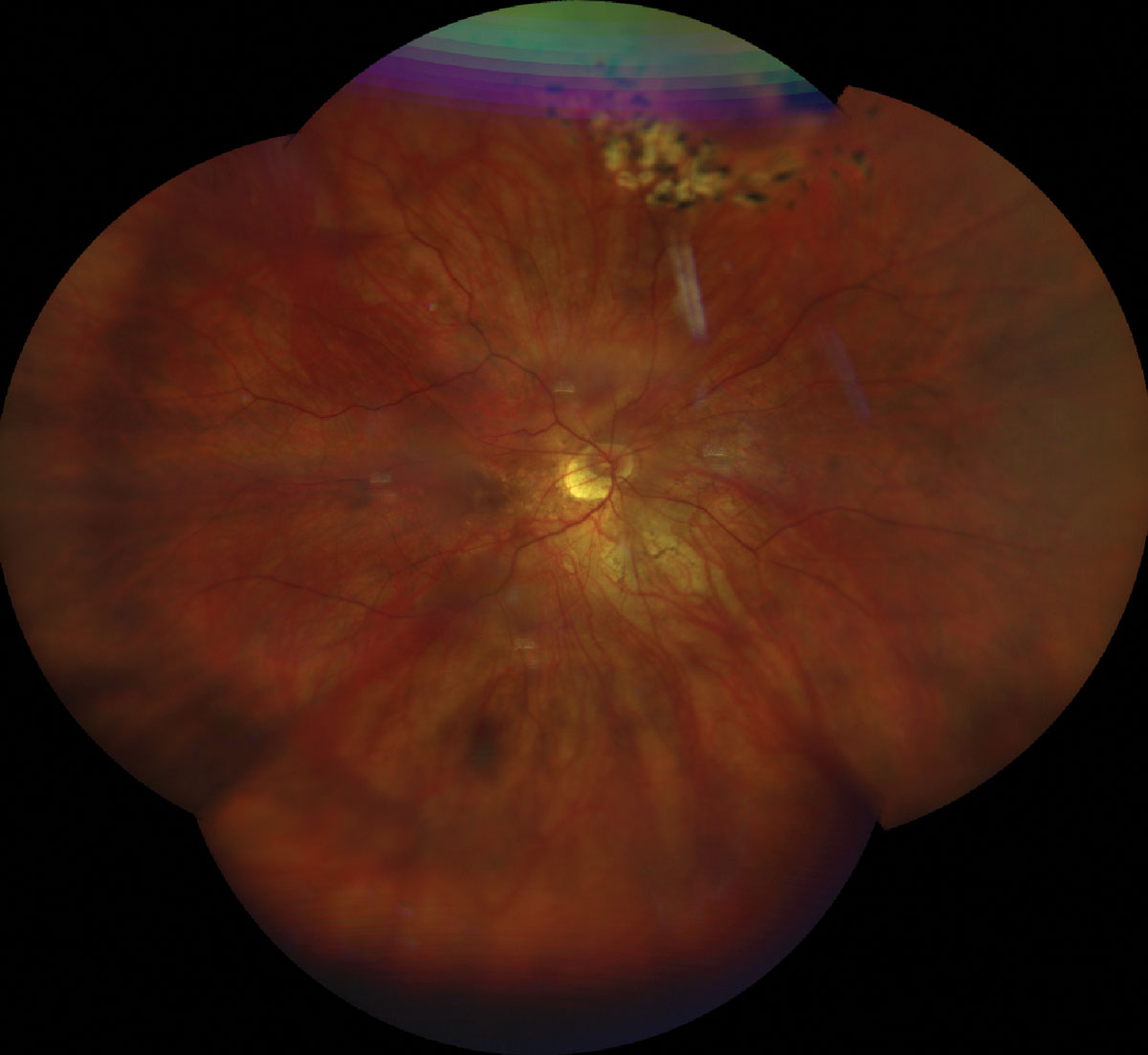 Almost 80% of Myopic Children Show Some Retinal Findings, BLINK Study Finds

Most common were disc anomalies, white without pressure and RPE changes. Some were seen even in low myopes.
Read the news story: reviewofoptometry.com/article/almost…

#myopia #optometry #vision #retina