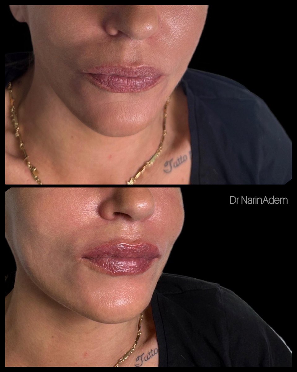 NariArdeni's tweet photo. Restylane Refyne -1 ml, преди и сшед филър в зона устни https://t.co/OnBIxeDqAd